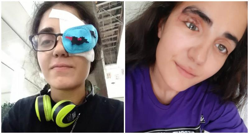 "ნახეთ... შრამი რომ არა, ვერც კი გაარჩევდით" - მაკო გომურს ხელოვნური თვალი ჩაუსვეს