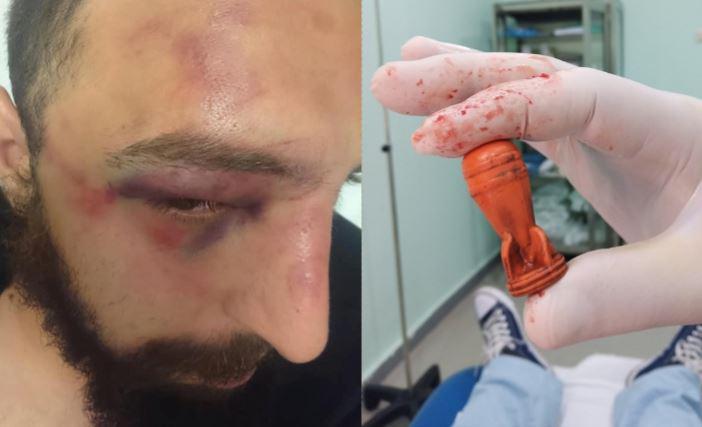 რას ყვებიან აქციის დარბევისას დაშავებულები და გამოიყენა თუ არა სპეცრაზმმა აკრძალული ტყვიები