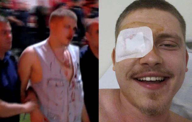 21 წლის სტუდენტს, რომელიც აქციიდან დასისხლიანებული გაიყვანეს, თვალი გადაურჩინეს - "როცა დაშავებულების გამოსაყვანად მიბრუნდა, მაშინ ესროლეს"