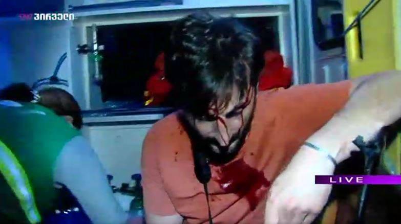 აქციის მონაწილეები სხეულის მძიმე დაზიანებებით - დემონსტრანტებს რეზინის ტყვიების კვალი ეტყობათ