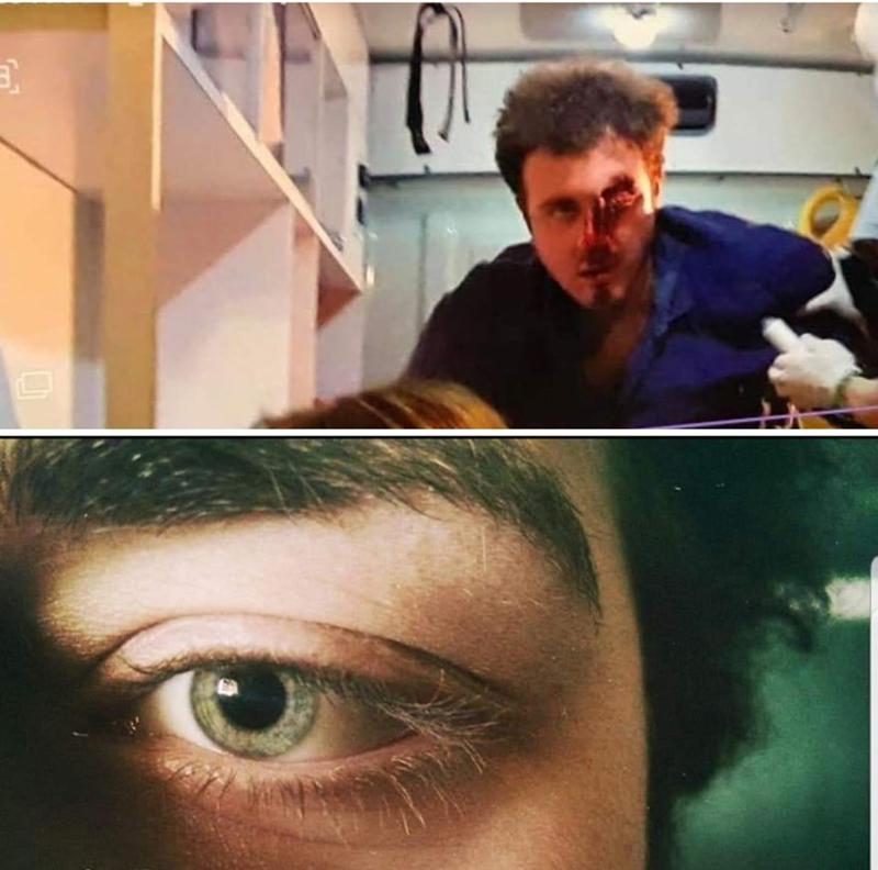 24 წლის ბიჭს, რომელზეც წერენ, რომ აქციის დაშლისას თვალი დაკარგა, ოპერაცია ახლა უტარდება