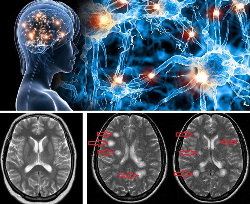 "ხშირად ვგრძნობ, ტკივილსგან  როგორ მელეწება თავის ქალა" - რა არის გაფანტული სკრელოზი და დააფინანსებს თუ არა მის მკურნალობას სახელმწიფო