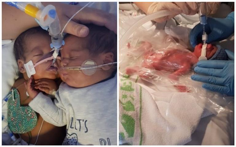 როგორ გადაარჩინა ტყუპისცალი ძმის ჩახუტებამ დღენაკლული ახალშობილი - ემოციური ფოტოს ისტორია