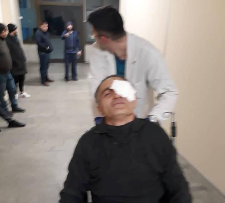 "თვალი გადმოუვარდა და თვითონ ჩაისვა" - როგორია მამაკაცის მდგომარეობა, რომელმაც ჭავლის გამო სახის დაზიანება მიიღო