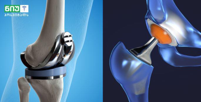 როგორ დავიბრუნოთ მოძრაობის უნარი - ოპერაცია, რომელსაც ასაკობრივი შეზღუდვა არ აქვს