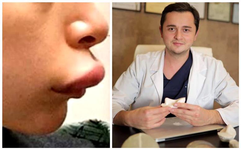 "ეს არის ბომბი... არავინ იცის, როდის დაჩირქდება" - პლასტიკური ქირურგი მძიმე შედეგებზე, რასაც E ვიტამინით ტუჩების და მკერდის გადიდება იწვევს