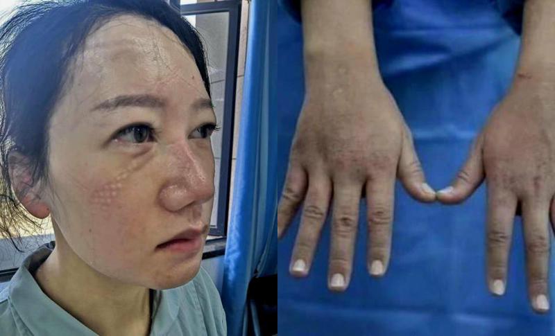 გამომშრალი და ნაწიბურებიანი კანი - რა მდგომარეობაში არიან ჩინელი მედიკოსები კორონავირუსთან უწყვეტ რეჟიმში ბრძოლის გამო