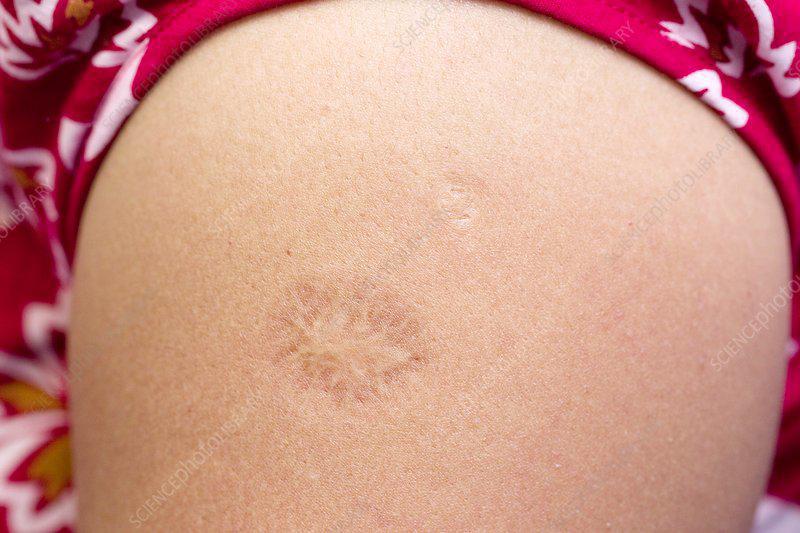 100 წლის წინ შექმნილი ვაქცინა, რომელიც შესაძლოა, კორონავირუსისგან იცავს - ის ქართველების უმეტესობას გაკეთებული აქვს