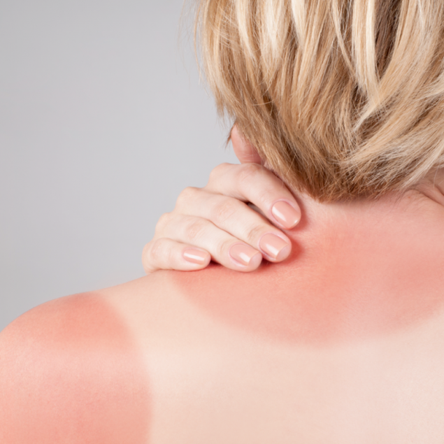 როგორ უნდა მივიღოთ რუჯი დამწვრობის გარეშე და როგორ მოვუაროთ გარუჯულ კანს?