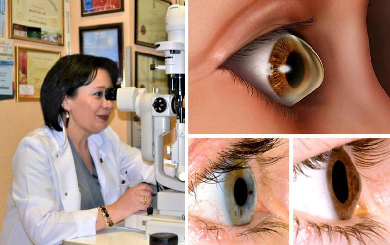 ბოლო დროს ყველაზე გავრცელებული თვალის დაავადება, რომელიც დიდხანს შეუმჩნეველია  - "მისი ყველაზე საშიში გართულება რქოვანას გახვრეტაა"