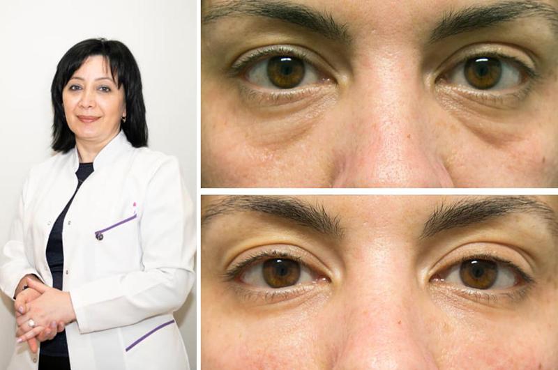 ქუთუთოების დაავადება, რომელიც ასაკის მატებასთან ერთად ვითარდება - ოფთალმოლოგი განმარტავს რა იწვევს მას და როგორ მკურნალობენ