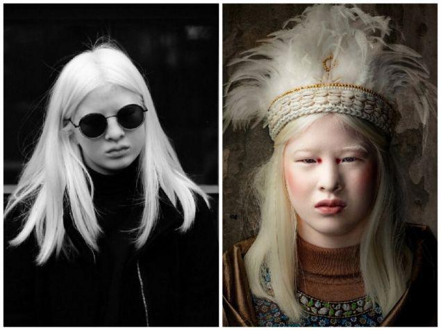 მშობლებისგან მიტოვებული ალბინოსი გოგონას გზა წარმატებამდე - როგორ დაამსხვრია ყველასგან უარყოფილმა მოდელმა სტერეოტიპები