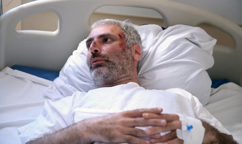 "სახეზეა თავის ტვინის შერყევა" - რას ამბობს ექიმი "ინტერპრესნიუსის" ფოტოგრაფის მდგომარეობაზე, რომელიც "პრაიდის" მოწინააღმდეგეებმა სცემეს