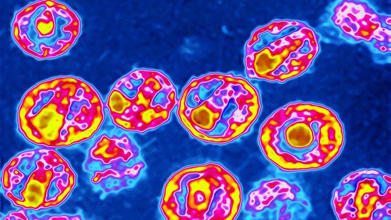 ისტორიაში პირველად - ქალი პაციენტი აივ ინფექციისგან სრულად განიკურნა