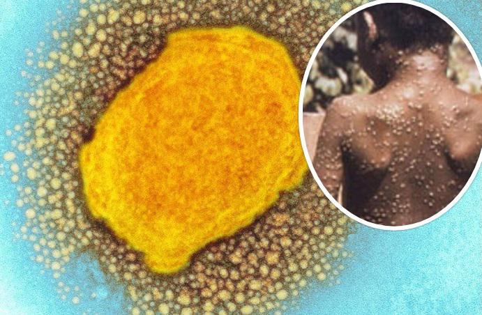 მსოფლიოს რამდენიმე ქვეყანაში ინფექციური დაავადება, მაიმუნის ყვავილი გამოვლინდა - რა სიმპტომები აქვს და არის თუ არა მისი ფართოდ გავრცელების საფრთხე?