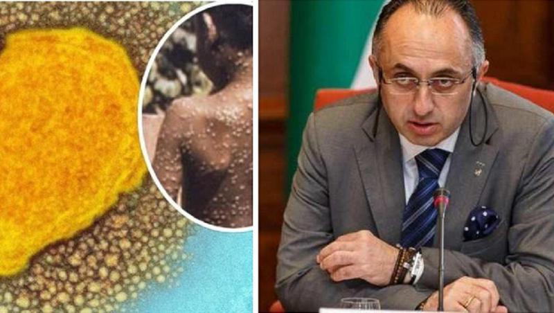 "ჯანმო-ს თეორიით, ეპიდემია გამოწვეულია სქესობრივი კონტაქტით" - რას წერს ზაზა წერეთელი "მაიმუნის ყვავილის" შესახებ, მისი გავრცელების გზებსა და ინფექციის სირთულეზე