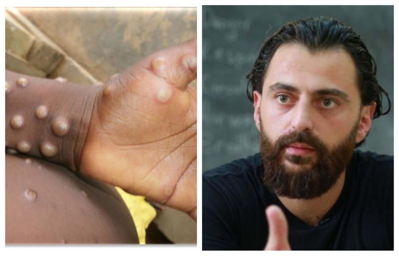 "მითია, რომ მის წინააღმდეგ მედიკამენტი არ არსებობს და თითქოს მნიშვნელობა ენიჭება სექსუალური ორიენტაციის კვლევას" - რას წერს ექიმი მაიმუნის ყვავილის თაობაზე გავრცელებულ ტყუილ-მართალზე?