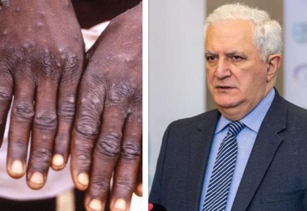 "პანიკის საფუძველი არ არის... ვისაც გაკეთებული აქვს ნატურალური ყვავილის საწინააღმდეგო აცრა, მათი იმუნიტეტი "მაიმუნის ყვავილის“ წინააღმდეგ მუშაობს" - ამირან გამყრელიძე