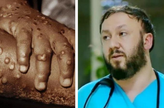 "ამ ორ შემთხვევაში აუცილებელია, კლინიკას მიმართოთ" - მოსალოდნელია თუ არა საქართველოში "მაიმუნის ყვავილის" მასობრივი გავრცელება: რას აცხადებს ინფექციონისტი ალექსანდრე გოგინავა