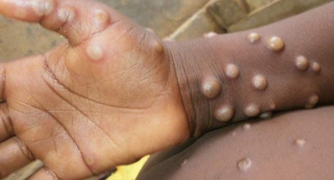 ჯანმო საგანგებო სხდომას გამართავს, სადაც გადაწყდება, "მაიმუნის ყვავილის“ გავრცელების გამო  გამოცხადდეს თუ არა ჯანმრთელობის განსაკუთრებული მდგომარეობა