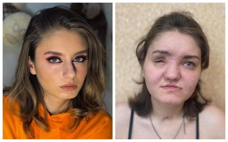 "ავარიამ დაანგრია ჩემი ცხოვრება - რეანიმაციიდან გამოწერის შემდეგ მიმატოვეს შეყვარებულმა და მეგობარმა..." - წამებში შეცვლილი ცხოვრება და გოგონა, რომელსაც დახმარება ესაჭიროება