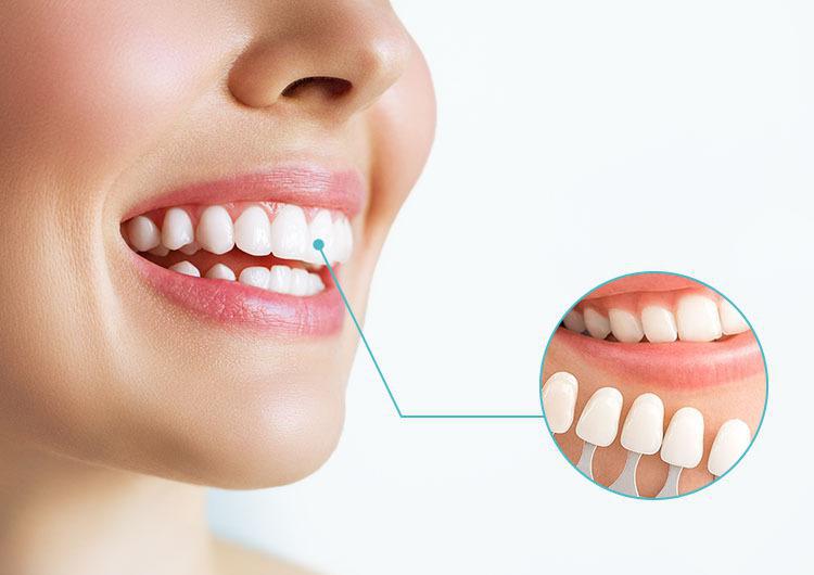 თეთრი და პრიალა კბილები ხანგრძლივად რომ შეინარჩუნოთ - ჰოლივუდური ღიმილის საიდუმლო