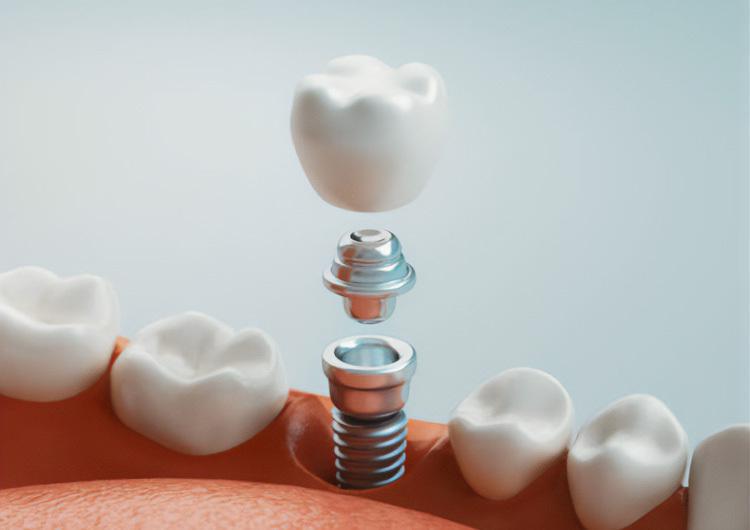 5 კითხვა, რომლებიც დენტალური იმპლანტის გაკეთებამდე უნდა დასვათ