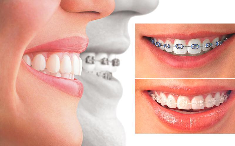 ყველაფერი, რაც ბრეკეტების შესახებ უნდა იცოდეთ