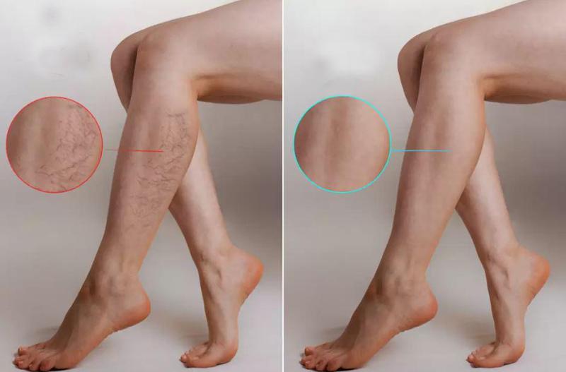 როგორ დავიცვათ თავი ვარიკოზისგან - 5 წესი, რომელიც უნდა გაითვალისწინოთ