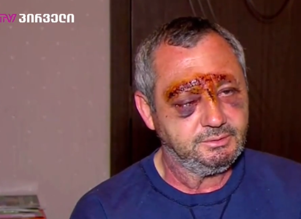 "უბრალოდ დევს თვალი, თორემ მხედველობის აღდგენის ვარიანტი აღარ არის" - მამაკაცი ამბობს, რომ აქციაზე მძიმედ დაშავდა