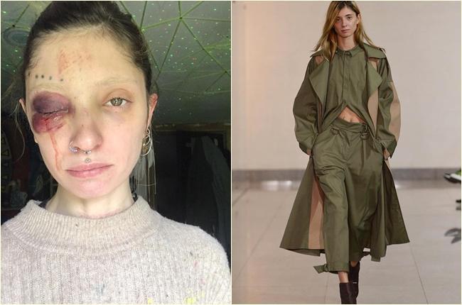 "ეს ბოლო წვეთია! ცრემლის ნაცვლად თვალიდან სისხლი მდის" -  მოდელი რენატა ბეგიაშვილი ძალადობაში ყოფილ მეუღლეს ადანაშაულებს: რას პასუხობს ბრალდებას მამაკაცი?