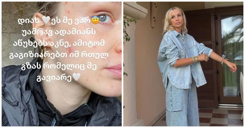 "უამრავ ადამიანს აწუხებს აკნე, გაგიზიარებთ იმ რთულ გზას, რომელიც მე გავიარე" - ანუკი არეშიძე თავის მოვლის რუტინაზე