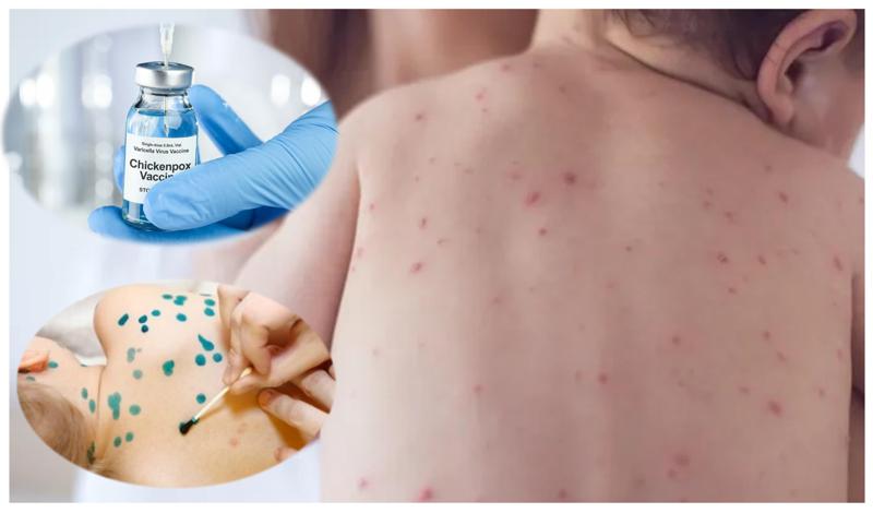 "არ გამოიყენოთ "ზელიონკა", ასპირინი და იბუპროფენი..." -  როგორ მოვუაროთ ბავშვს "ჩუტყვავილას" დროს და რატომ არ შედის ვაქცინაციის კალენდარში აღნიშნული დაავადება?