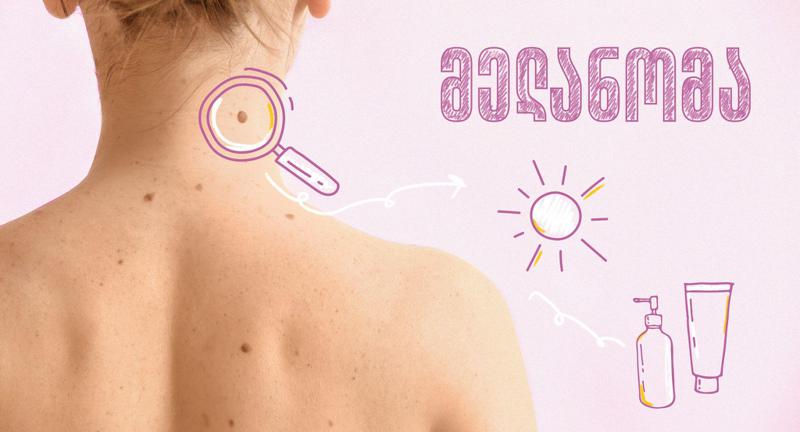 მელანომა: როგორ ამოვიცნოთ კანის ყველაზე ვერაგი სიმსივნე?