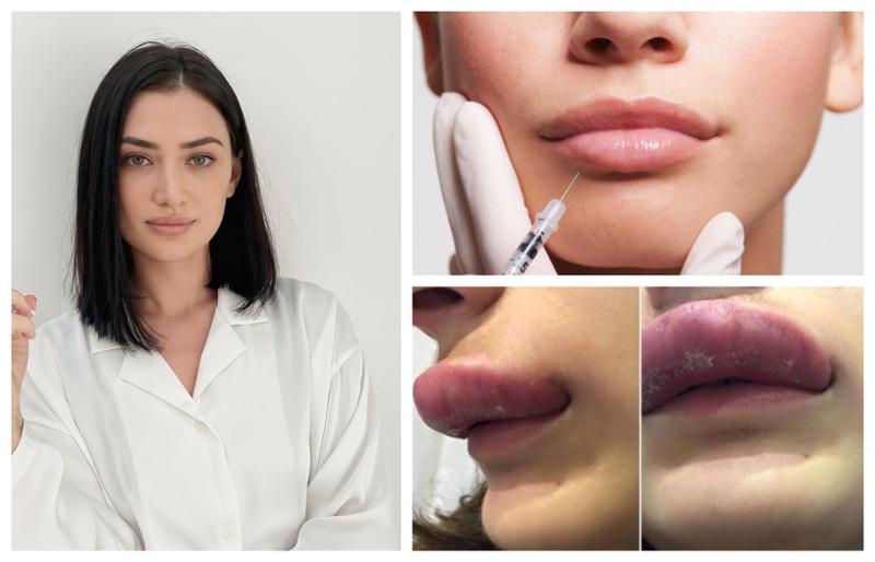 ვისთვის იკრძალება ფილერის გაკეთება და რა რისკები ახლავს E ვიტამინს, რომელსაც "ჩუმ ბომბს" უწოდებენ -  "შეიძლება პაციენტს დაეწყოს ტუჩის შეშუპება და ალეგია": რას გვირჩევს სპეციალისტი?