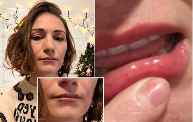 "ტუჩზე გამიჩნდა ე.წ. ბურთები, სიწითლე, სიმაგრე. ექიმებმა მითხრეს, რომ ფილერი არასწორ შრეში გამიკეთეს" - ახალგაზრდა ქალი ამბობს, რომ საქართველოში ტუჩის აუგმენტაცია არასწორად ჩაუტარეს