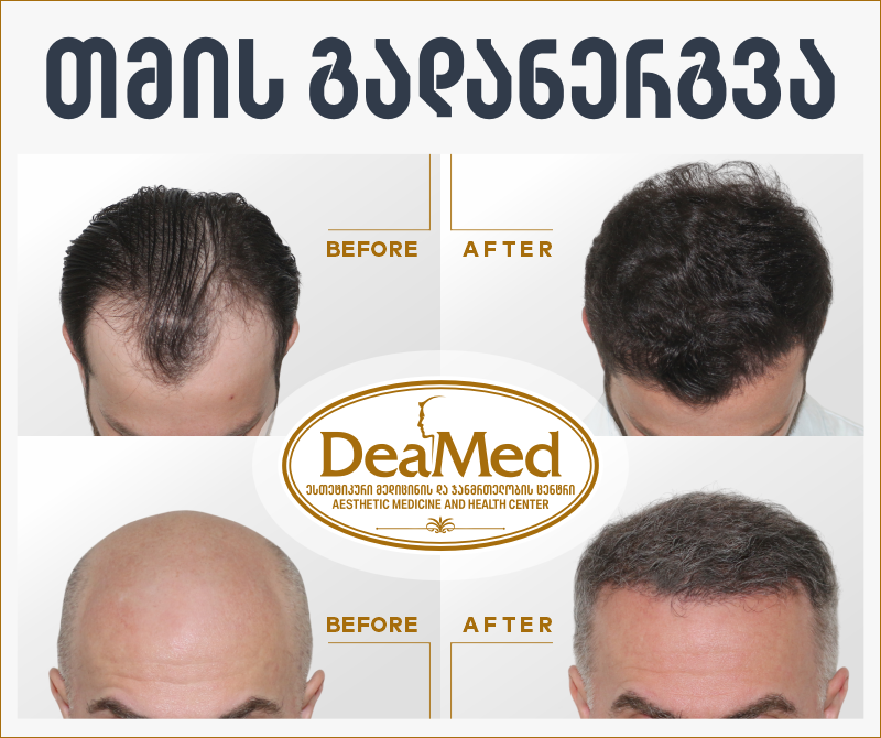 როდის ვეუბნებით უარს პაციენტს თმის გადანერგვაზე და რა არის ამ შემთხვევაში გამოსავალი - "დეამედის“ პლასტიკური ქირურგის, პროფესორის დეა პაპასკირის რჩევა-რეკომენდაციები