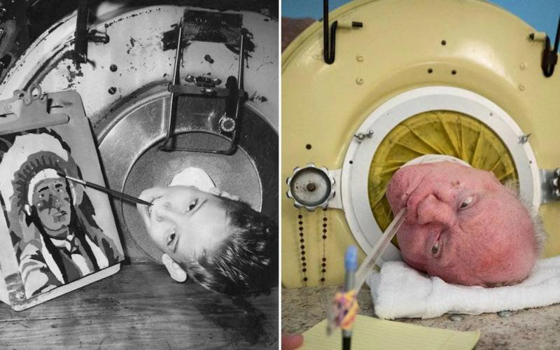 ცხოვრება "რკინის ფილტვებში": როგორ გაატარა კაცმა 70 წელი კაფსულაში - "გახდა ადვოკატი, წერდა მემუარებს კბილებს შორის ჩამაგრებული კალმით"