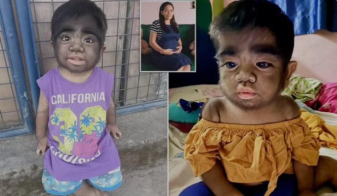 "მაქციის სინდრომით" დაბადებული ბავშვის დედა ამბობს, რომ ორსულობისას კატის ხორცი ჭამა, რამაც "მისი შვილის ეს მდგომარეობა გამოიწვია" - ფილიპინელი ბიჭის უმძიმესი ისტორია