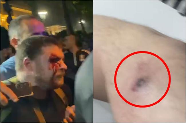 აქციის მონაწილეების ინფორმაციით, სამართალდამცველებმა მათ წინააღმდეგ რეზინის ტყვიებიც გამოიყენეს