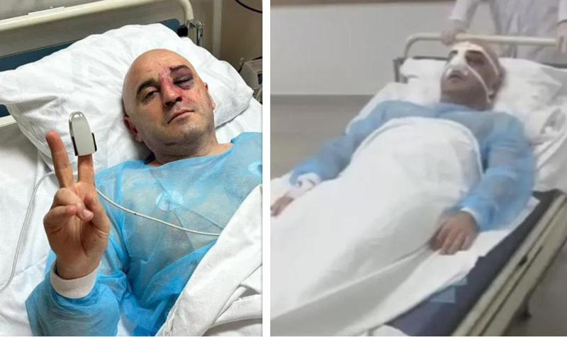 ლევან ხაბეიშვილს ოპერაცია ცხვირზე ჩაუტარდა - რას აცხადებენ ენმ-ში პარტიის თავმჯდომარის მდგომარეობის შესახებ?