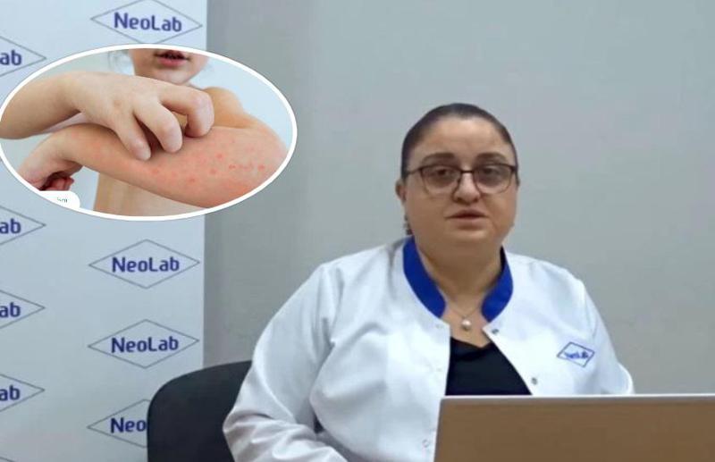 "მკვეთრად მოიმატა პარვოვირუსმა, იგივე "მეხუთე დაავადებამ", როგორც ბავშვებში ისე მოზრდილებში" - რას გვირჩევს ინფექციონისტი?