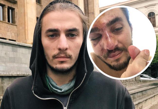 "შევყავარ ცხვირის ოპერაციაზე, კიდე რაღაც პატარა ძვალი არის გატეხილი..." - როგორია ზუკა ბერძენიშვილის მდგომარეობა: რას წერს სამოქალაქო აქტივისტი