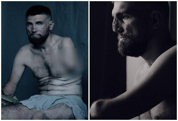 "ეს არის ომის სახე - ზახარი დრონის აფეთქების შედეგად დაშავდა" - ისტორია უკრაინელ ჯარისკაცზე, რომელიც ცნობილი ფოტოგრაფის ობიექტივში მოხვდა