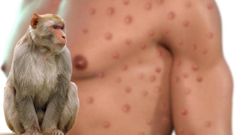 გაერთიანებულ სამეფოში მაიმუნის ყვავილის ორი ახალი შემთხვევა გამოვლინდა - რა ხდება ცნობილი?