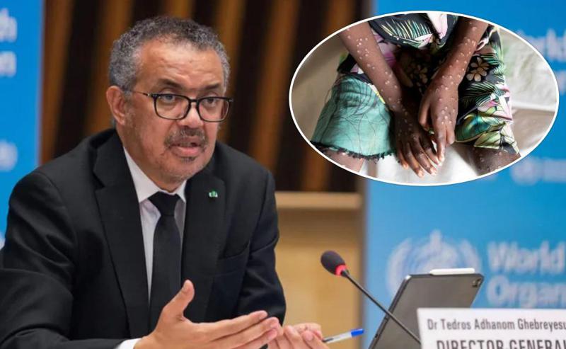 ჯანმო აცხადებს საგანგებო მდგომარეობას "მაიმუნის ყვავილთან" დაკავშირებით - რომელ ქვეყნებს მოედო ინფექცია?