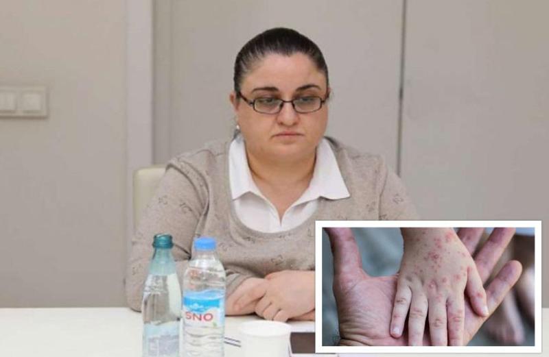 "მაიმუნის ყვავილს" დასაწყისში გრიპისმაგვარი სიმპტომები ახასიათებს" - ვისთვის არის საშიში ვირუსი, რომელთან დაკავშირებით ჯანმომ საგანგებო მდგომარეობა გამოაცხადა