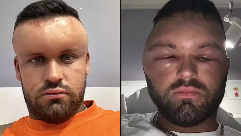 თმის საღებავის ალერგიამ საშინელი შედეგი გამოიწვია - "'თავდაპირველად ოდნავ დამწვა, მაგრამ მეგონა, რომ ასეც უნდა ყოფილიყო... მეორე დილით უარესი მოხდა"