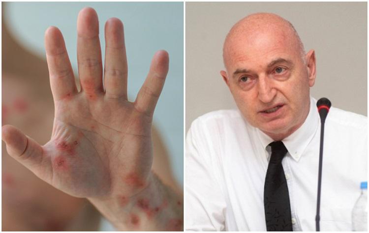 “1980 წლამდე დაბადებულებს, ვისაც ყვავილის საწინააღმდეგო ვაქცინა აქვს გაკეთებული, “მაიმუნის ყვავილის“ წინააღმდეგ გარკვეული დაცვა აქვს“ - ივანე ჩხაიძე