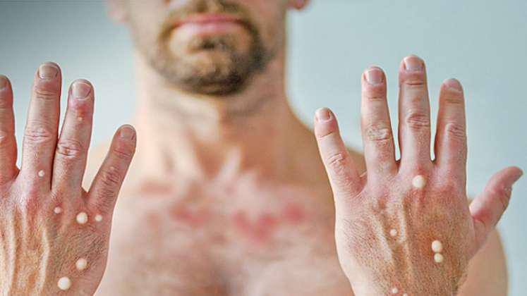 "მაიმუნის ყვავილი" არ გადადის არც ჰაერწვეთოვანი და არც სქესობრივი გზით" - მაშ, რატომ დაუკავშირდა სექსს და ხომ არ ვდგავართ შემდეგი პანდემიის წინაშე?